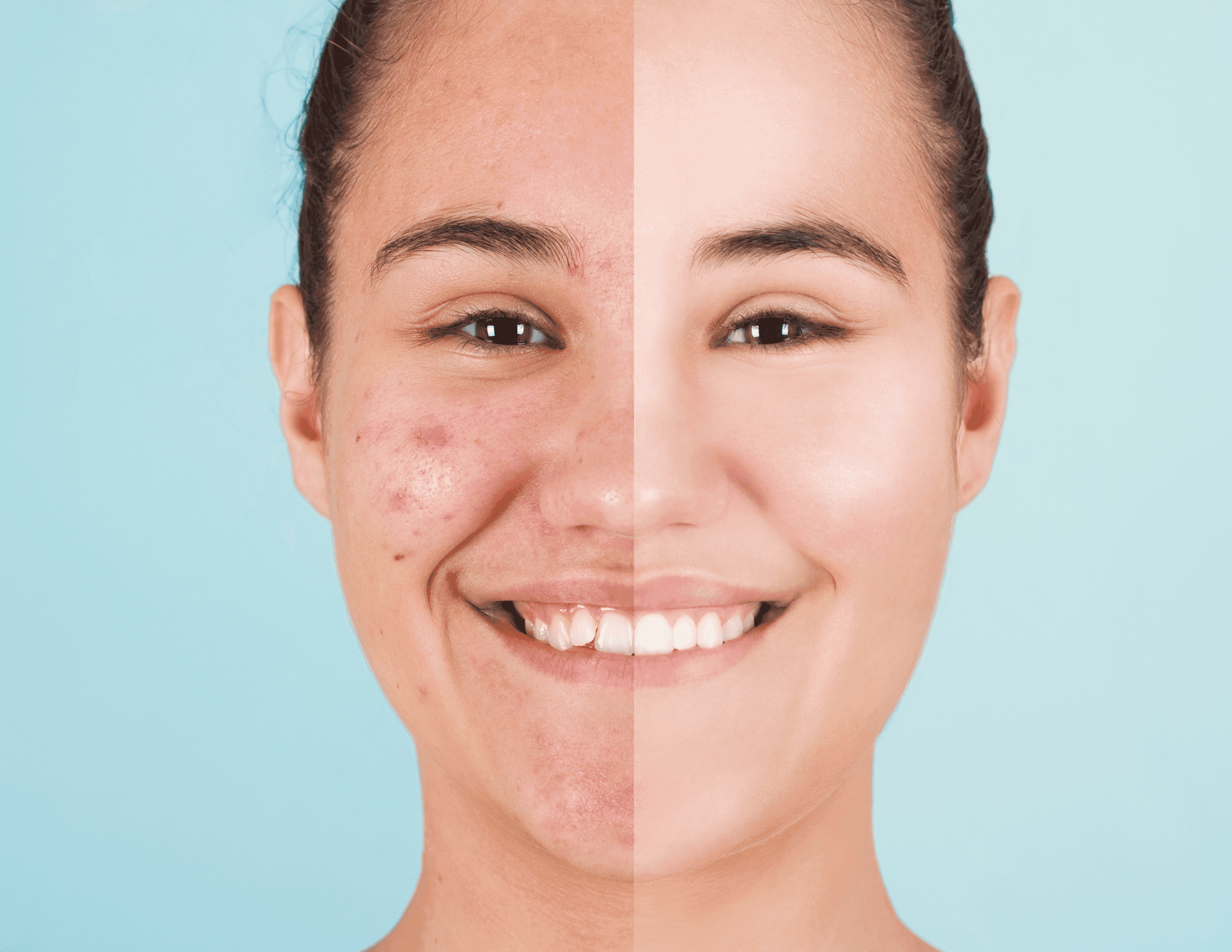 Acne Treatment Facial
