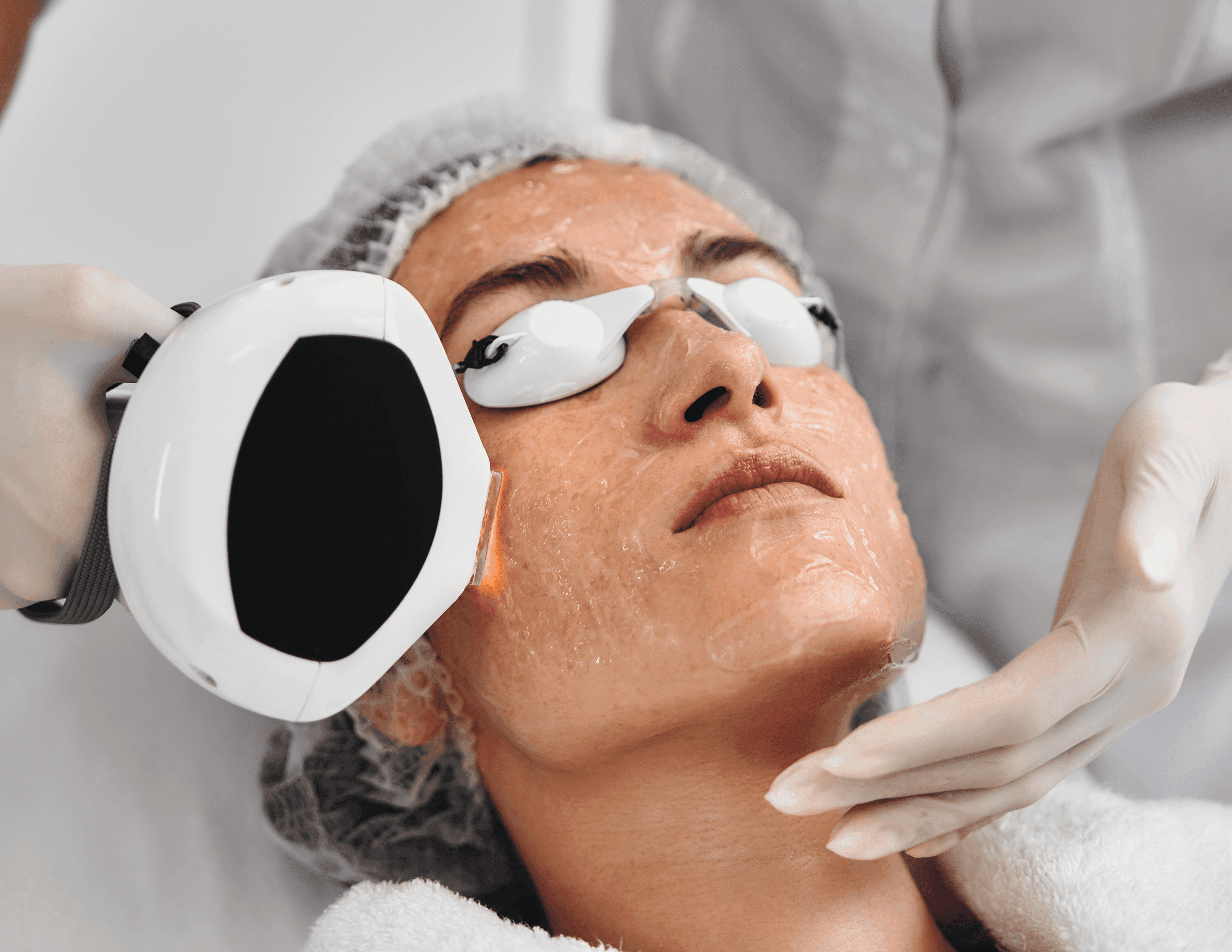 IPL Photo Facial