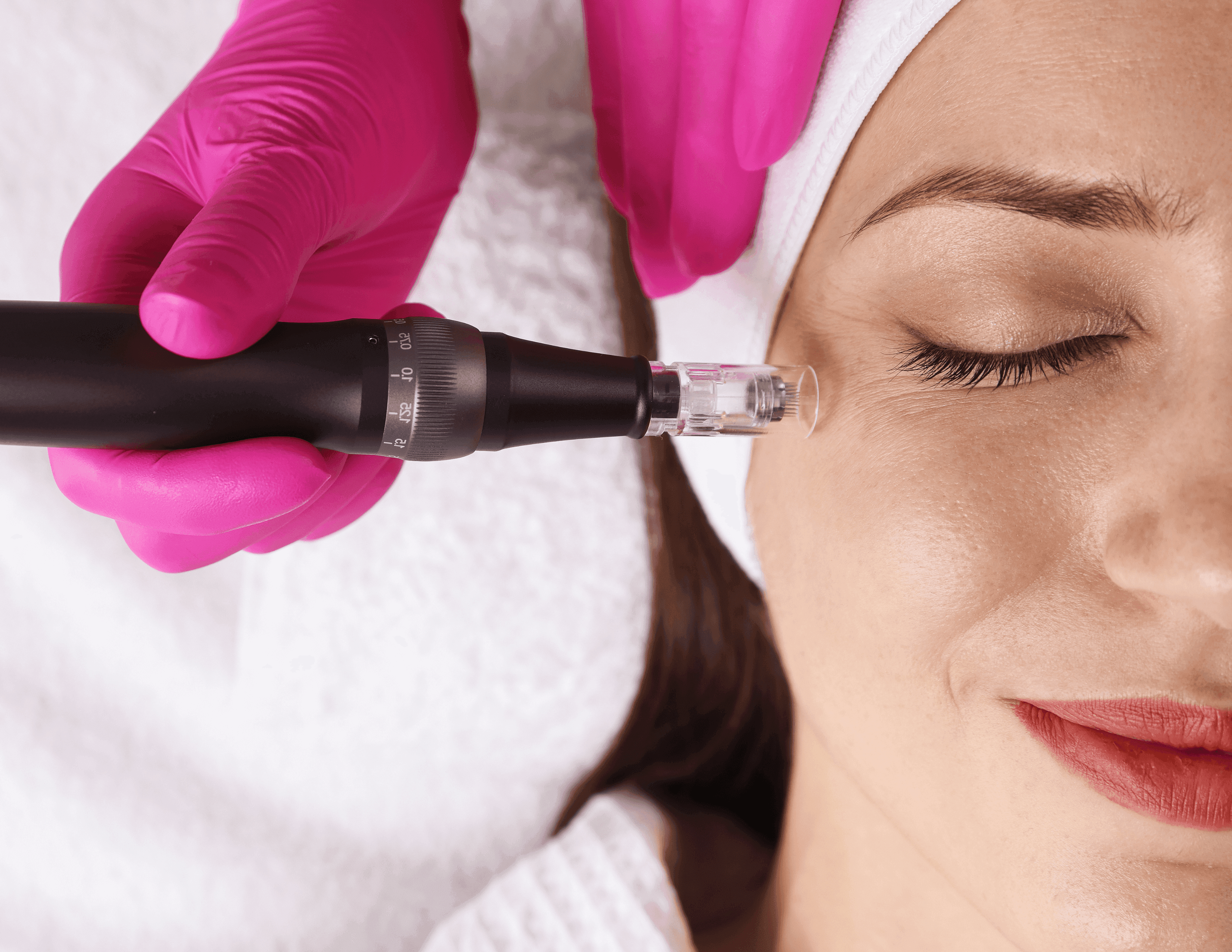 MicroNeedling
